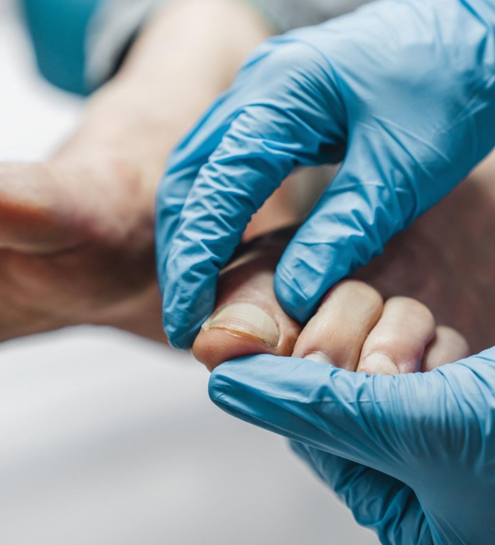 Alteraciones Ungueales (hongos, uñas encarnadas)