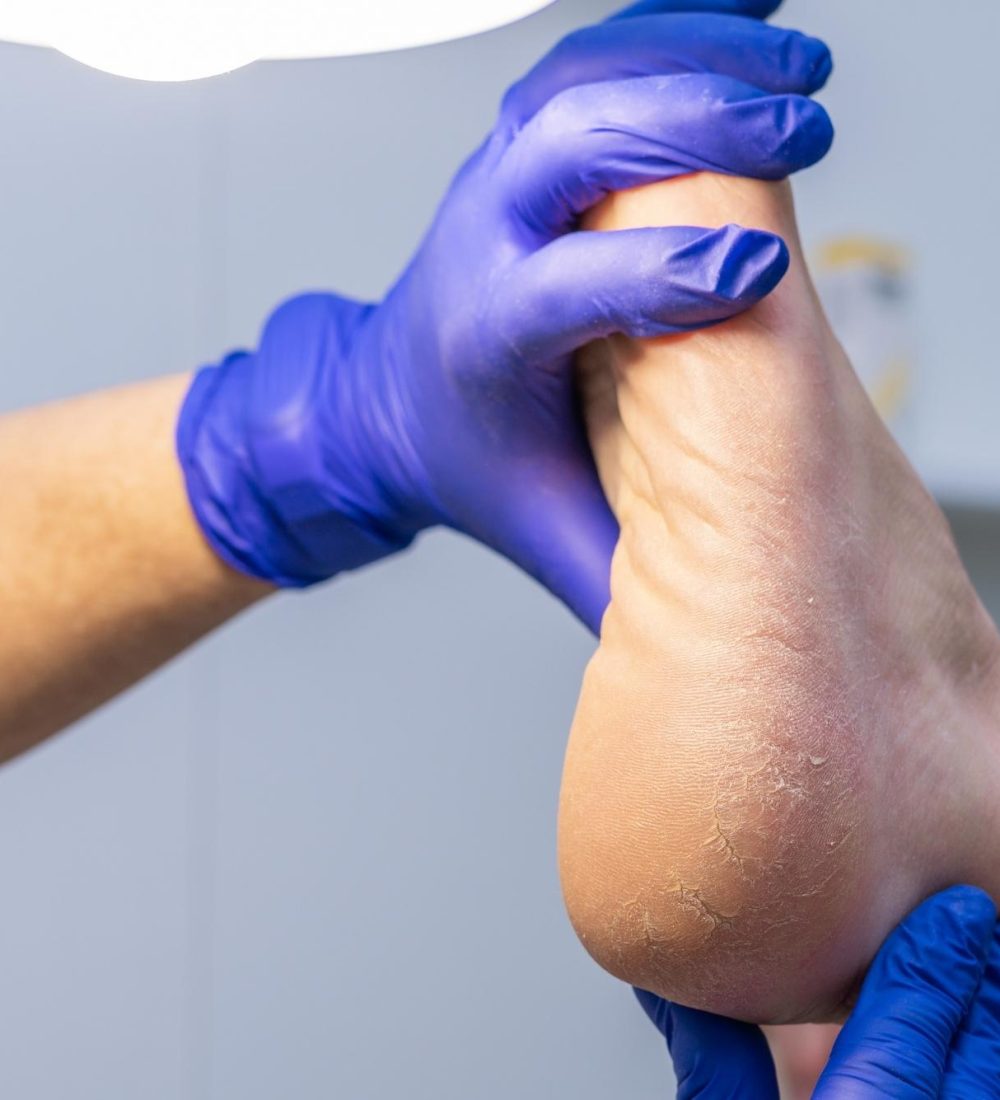 Hiperqueratosis (Durezas)