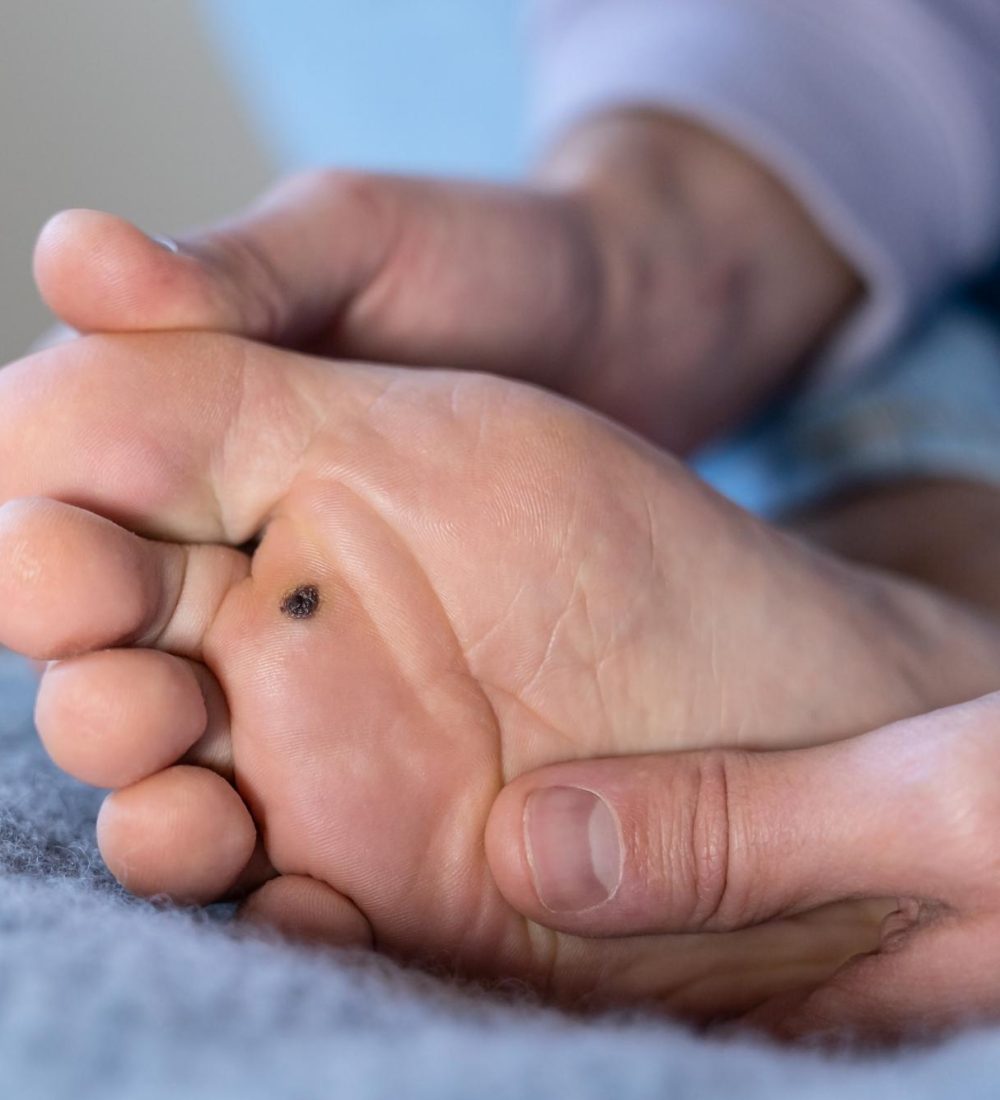 Papilomas (Verrugas Plantares)